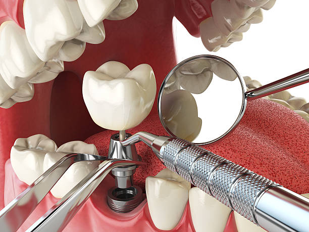 Best Emergency Tooth Extraction in Galesville, MD